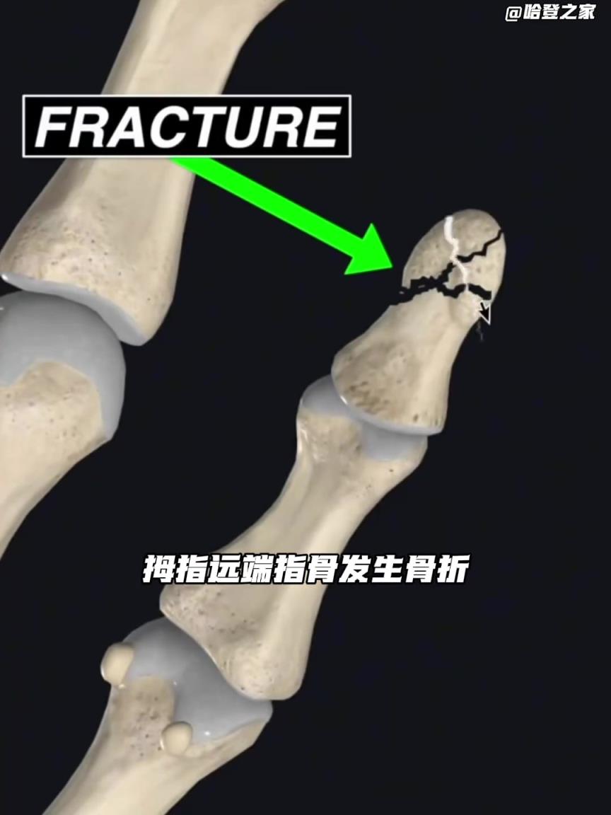 专业！国外知名运动康复博主分析登哥手指伤势：带护具就能打