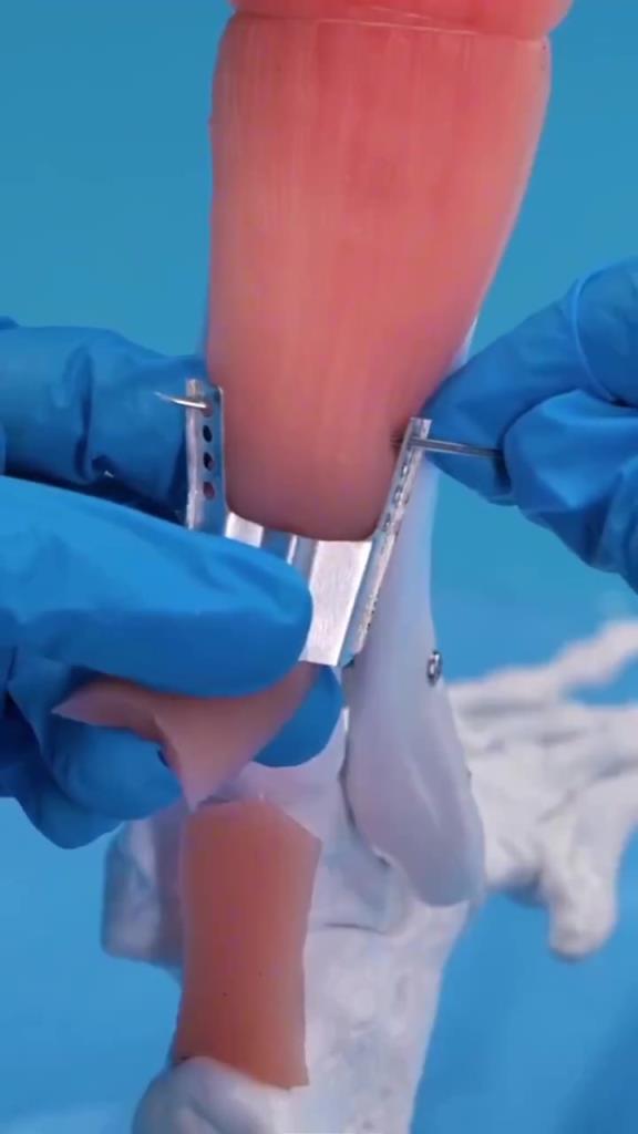 跟腱手术是什么？一个视频带你看医生修复跟腱撕裂的全过程